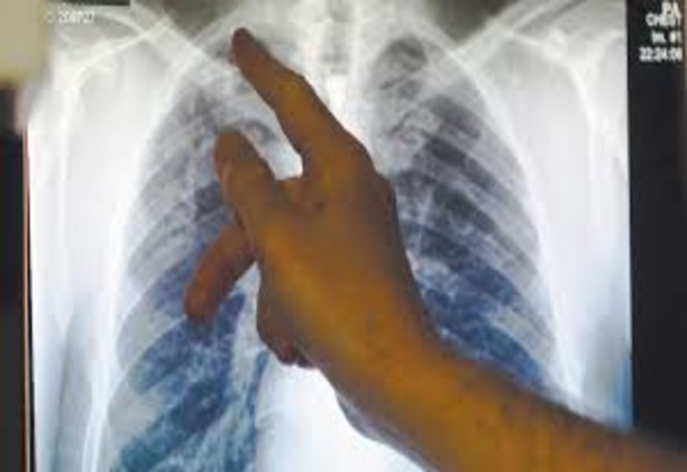 OMS: TUBERCULOZA, DIN NOU PE PRIMUL LOC ÎNTRE BOLILE INFECŢIOASE FATALE